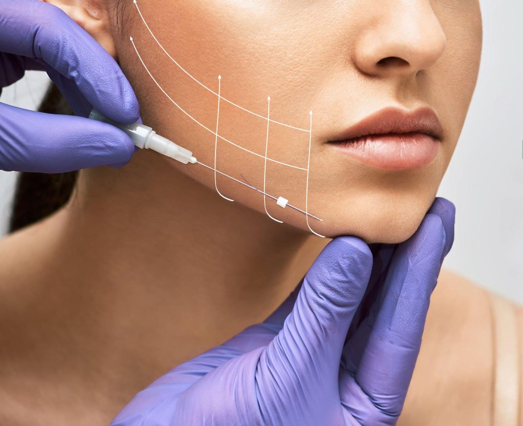 Thread Lift Procedure in Bangalore