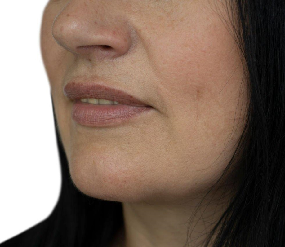 Women Face HIFU Facial after Treatment