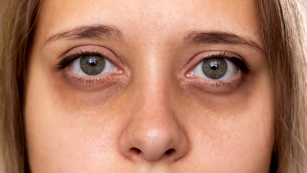 Can You Get Rid Of Your Dark Circles