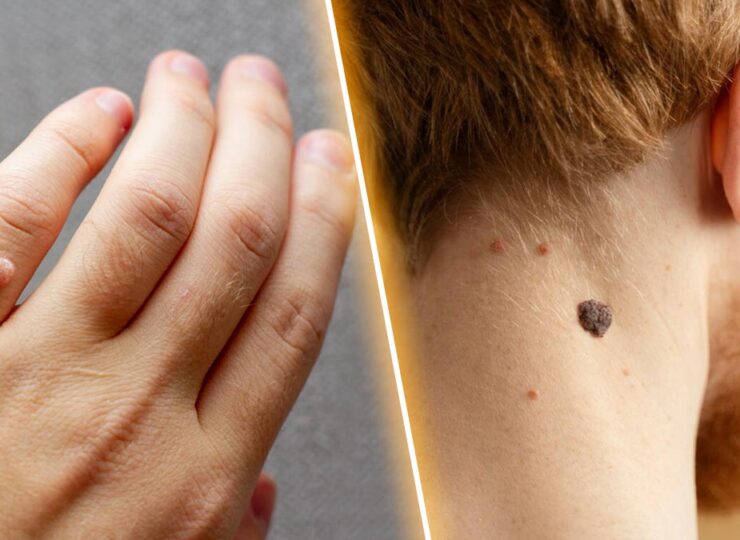 skin Tags Vs Warts: Expert Explains The Differences Between The Two