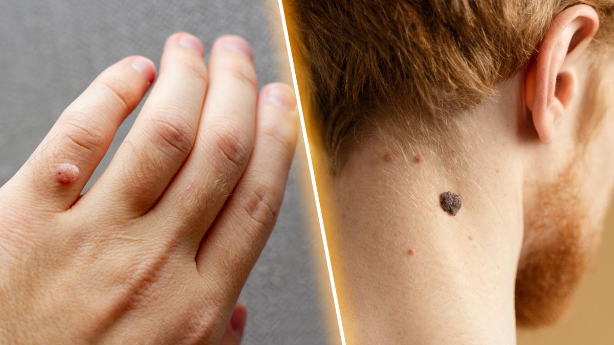 skin Tags Vs Warts Expert Explains The Differences Between The Two