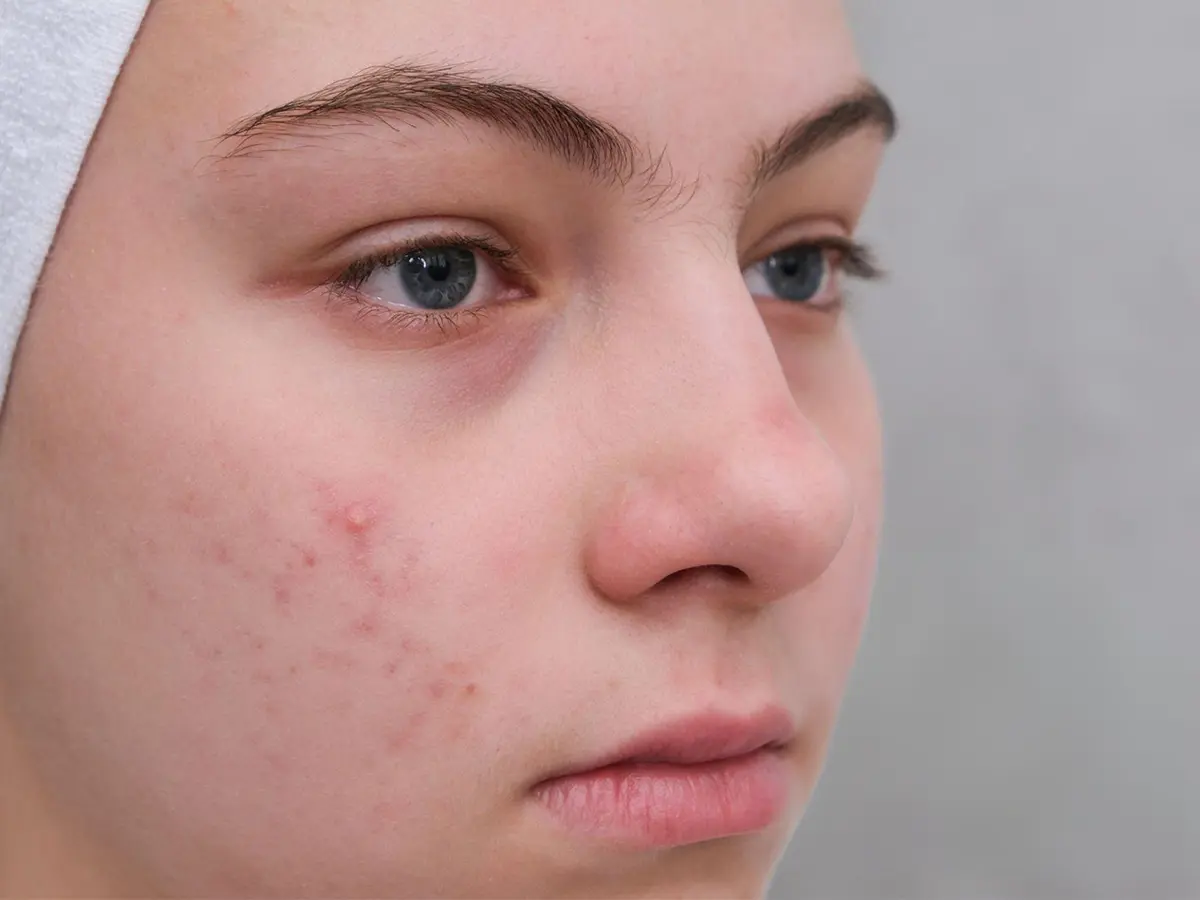 Home Remedies For Cystic Acne