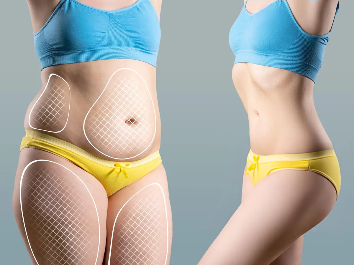 Laser Lipolysis: What It Is, Benefits, Cost, And Procedure