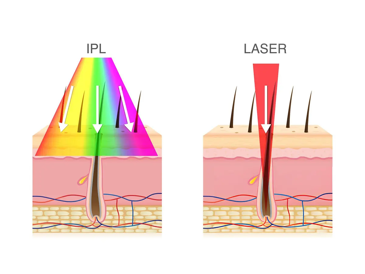 laser vs IPL hair removal