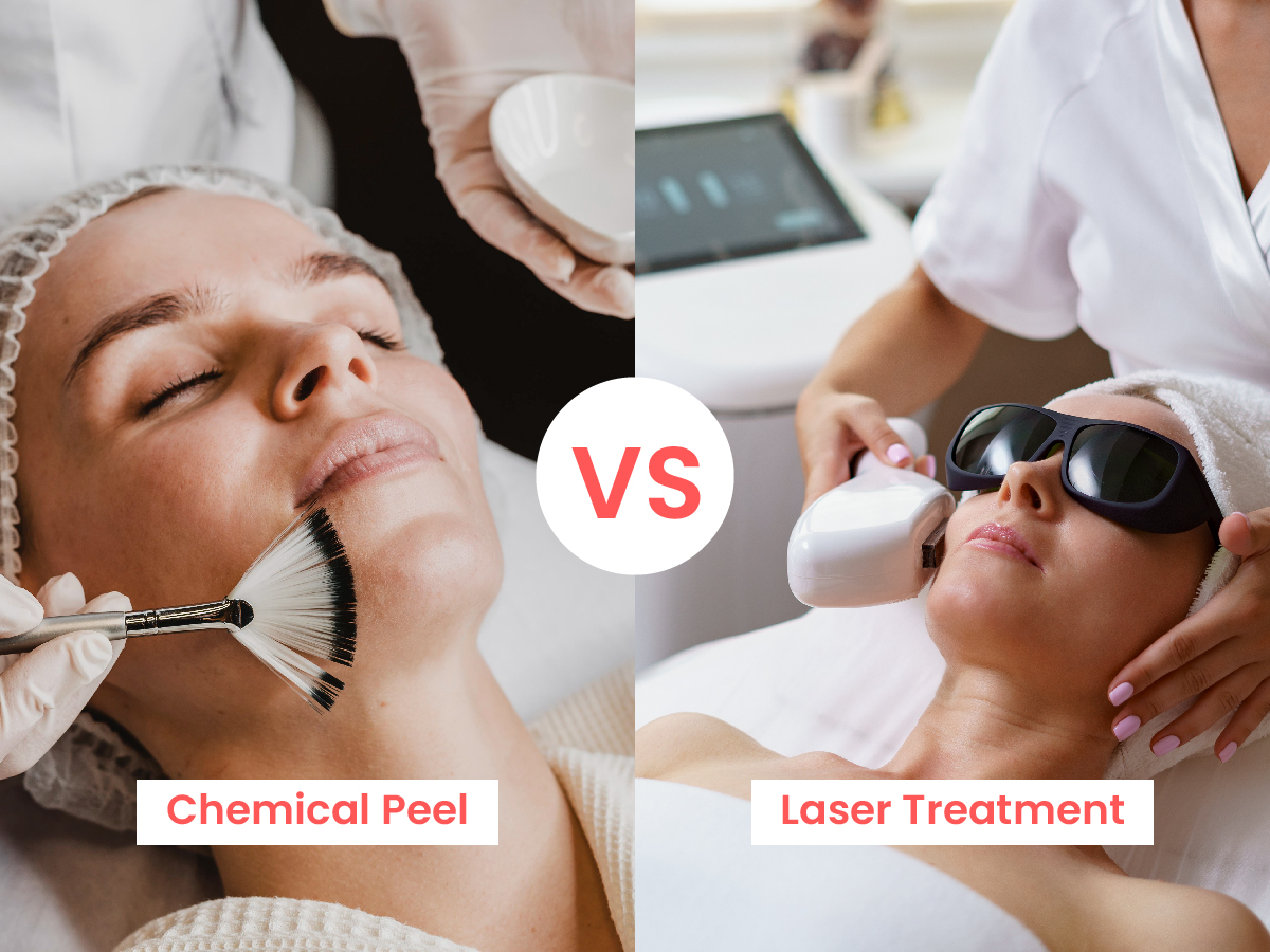 Chemical Peel vs Laser Treatment