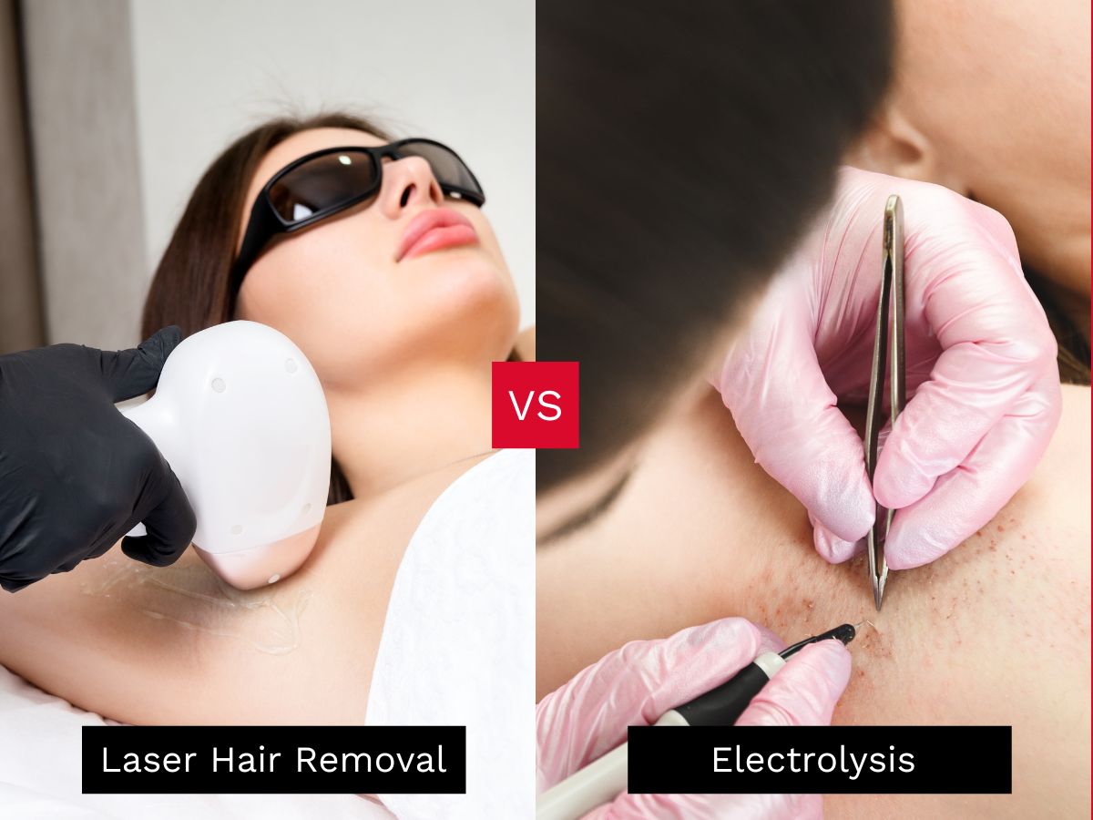 Laser Hair Removal vs Electrolysis