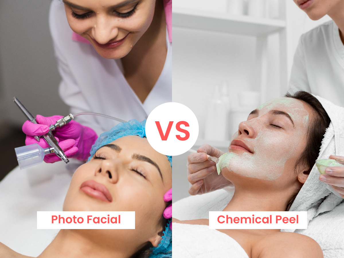 Photo Facial vs Chemical Peel