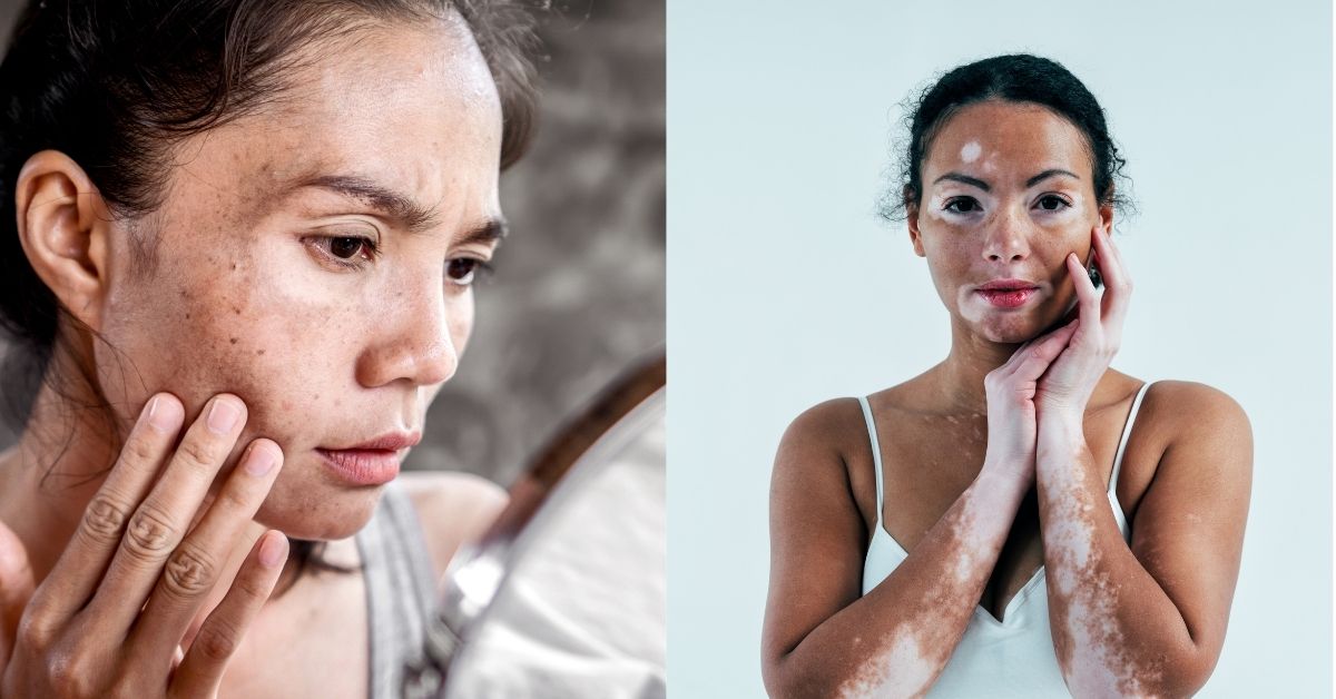 Hypopigmentation vs Vitiligo