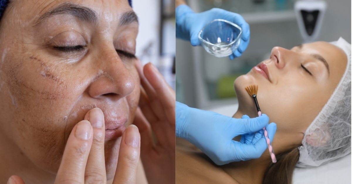 Chemical Peel at Home vs. In-Clinic